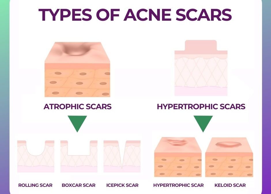 Acne Scar  Solution